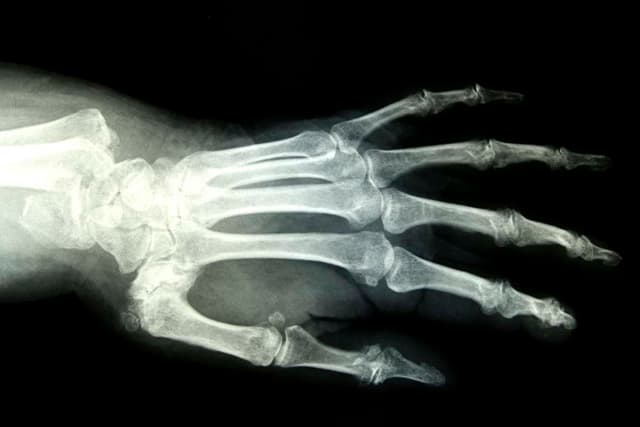 X-ray of a wrist fracture